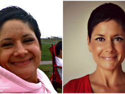 Melasma Before After